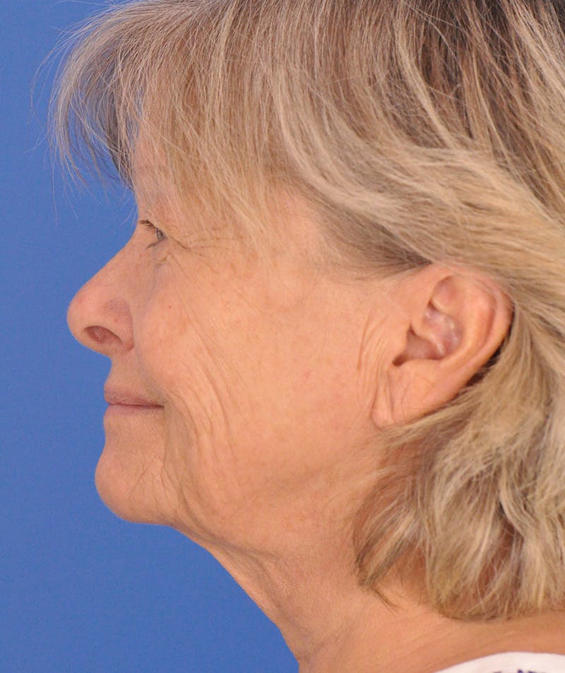 Facelift Before & After Gallery - Patient 114539 - Image 9