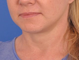 Neck Lift Before & After Gallery - Patient 122286 - Image 8