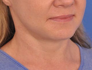 Neck Lift Before & After Gallery - Patient 122286 - Image 4