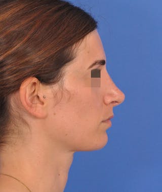 Rhinoplasty Before & After Gallery - Patient 398005 - Image 2