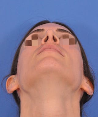 Rhinoplasty Before & After Gallery - Patient 398005 - Image 8
