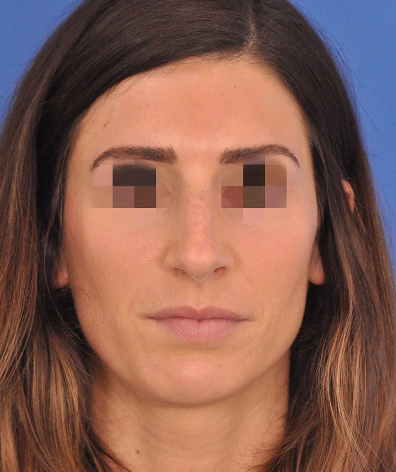 Rhinoplasty Before & After Gallery - Patient 398005 - Image 5