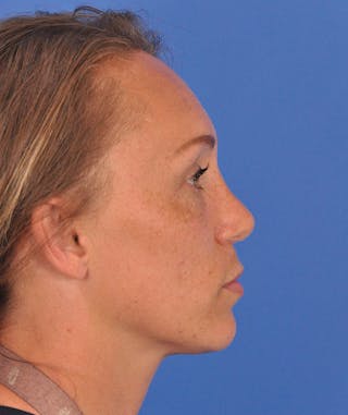 Rhinoplasty Before & After Gallery - Patient 323292 - Image 2