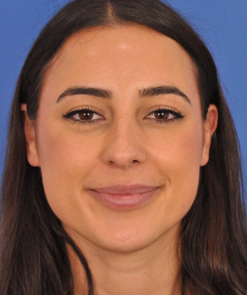 Rhinoplasty Before & After Gallery - Patient 788052 - Image 5