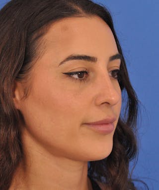 Rhinoplasty Before & After Gallery - Patient 788052 - Image 2