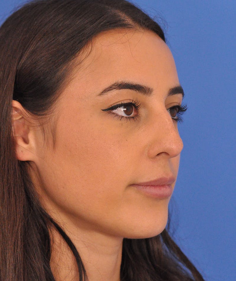 Rhinoplasty Before & After Gallery - Patient 788052 - Image 1