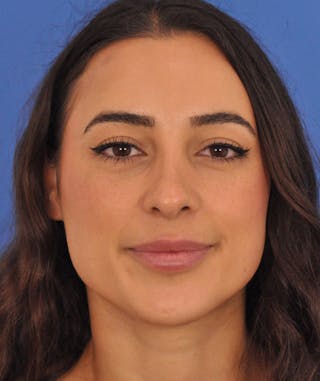 Rhinoplasty Before & After Gallery - Patient 788052 - Image 6