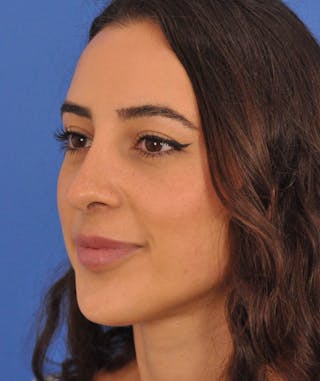 Rhinoplasty Before & After Gallery - Patient 788052 - Image 8