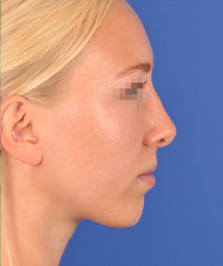 Rhinoplasty Before & After Gallery - Patient 379898 - Image 2