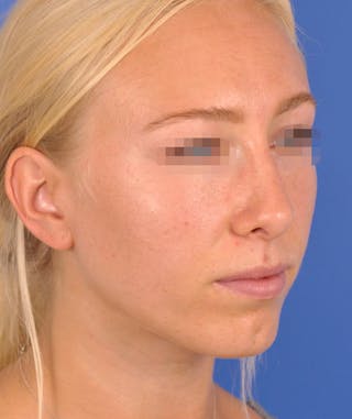 Rhinoplasty Before & After Gallery - Patient 379898 - Image 6
