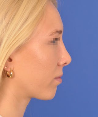 Rhinoplasty Before & After Gallery - Patient 379898 - Image 4