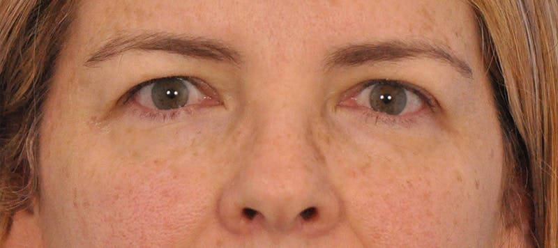 Blepharoplasty Before & After Gallery - Patient 152543 - Image 1