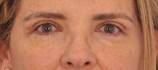 Blepharoplasty Before & After Gallery - Patient 152543 - Image 2