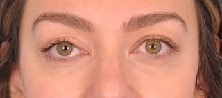 Blepharoplasty Before & After Gallery - Patient 280564 - Image 2