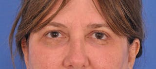 Blepharoplasty Before & After Gallery - Patient 207027 - Image 2