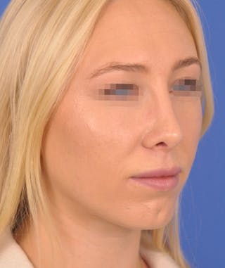 Rhinoplasty Before & After Gallery - Patient 379898 - Image 8