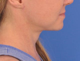 Neck Lift Before & After Gallery - Patient 122286 - Image 2