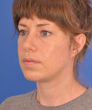 Neck Lift Before & After Gallery - Patient 110050 - Image 8