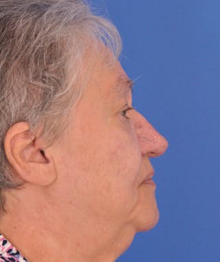 CO2RE Laser Before & After Gallery - Patient 305140 - Image 6