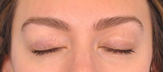 Blepharoplasty Before & After Gallery - Patient 280564 - Image 4