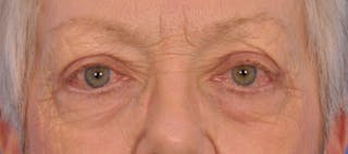 Blepharoplasty Before & After Gallery - Patient 254454 - Image 2