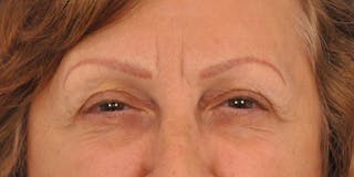 BOTOX Before & After Gallery - Patient 297820 - Image 2
