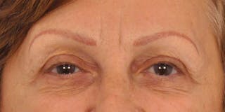 BOTOX Before & After Gallery - Patient 297820 - Image 8