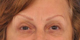 BOTOX Before & After Gallery - Patient 297820 - Image 4