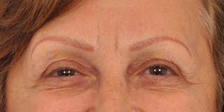 BOTOX Before & After Gallery - Patient 297820 - Image 6