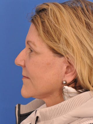 Facelift Before & After Gallery - Patient 305912 - Image 10
