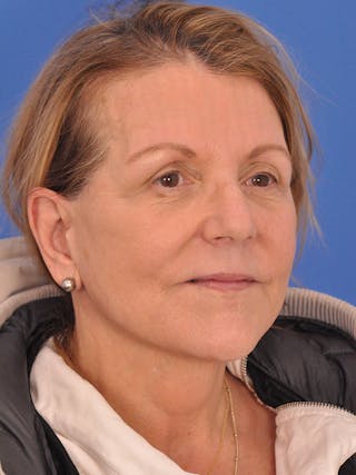 Facelift Before & After Gallery - Patient 305912 - Image 4