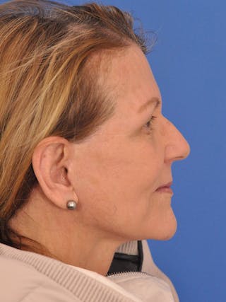 Facelift Before & After Gallery - Patient 305912 - Image 6