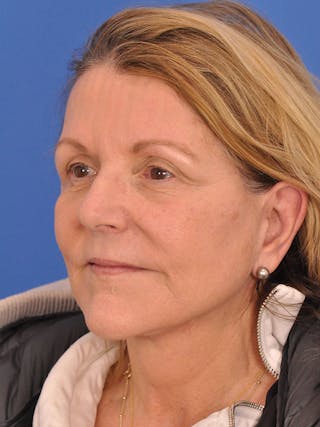 Facelift Before & After Gallery - Patient 305912 - Image 8
