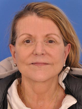 Facelift Before & After Gallery - Patient 305912 - Image 2