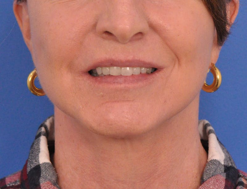 Facelift Before & After Gallery - Patient 145719 - Image 2
