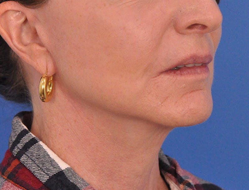 Facelift Before & After Gallery - Patient 145719 - Image 4