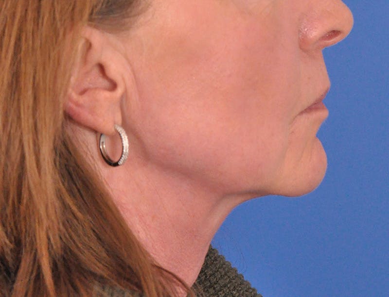 Facelift Before & After Gallery - Patient 145719 - Image 5