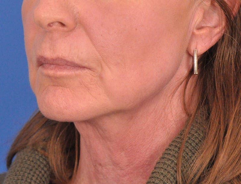 Facelift Before & After Gallery - Patient 145719 - Image 7