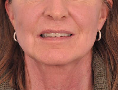 Facelift Before & After Gallery - Patient 145719 - Image 1