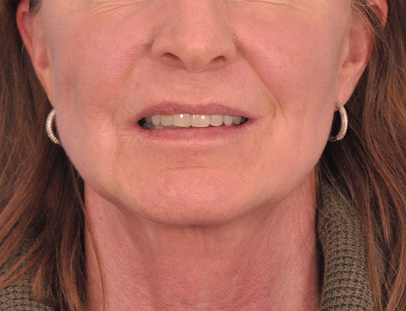 Facelift Before & After Gallery - Patient 145719 - Image 1