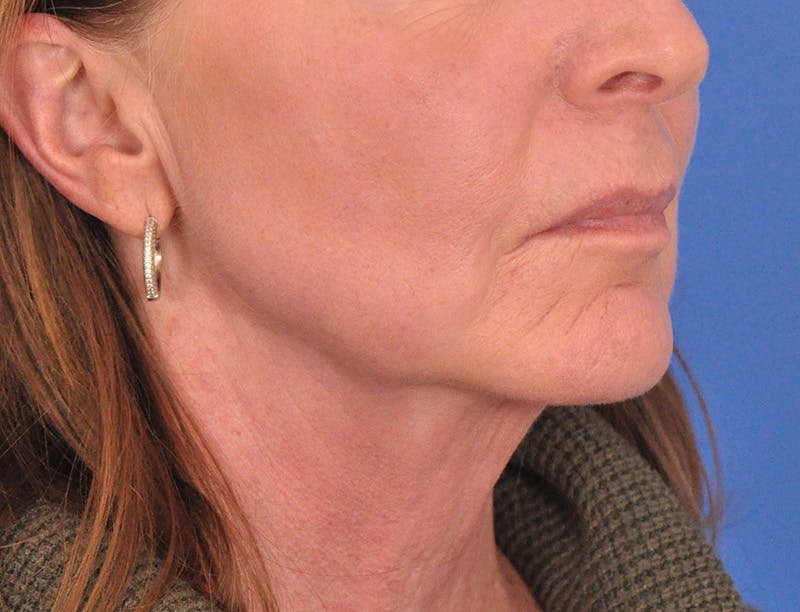 Facelift Before & After Gallery - Patient 145719 - Image 3