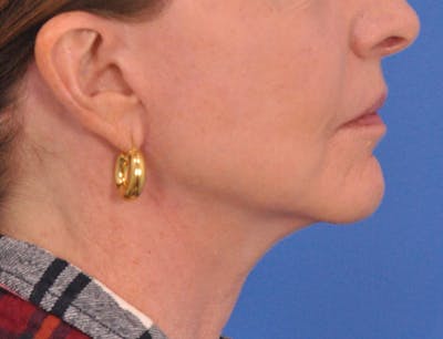 Neck Lift Before & After Gallery - Patient 128374 - Image 2