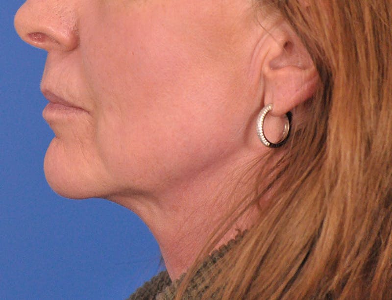 Facelift Before & After Gallery - Patient 145719 - Image 9