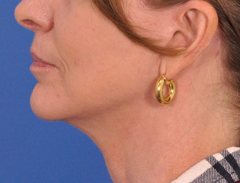 Facelift Before & After Gallery - Patient 145719 - Image 10