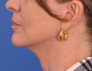 Neck Lift Before & After Gallery - Patient 128374 - Image 10