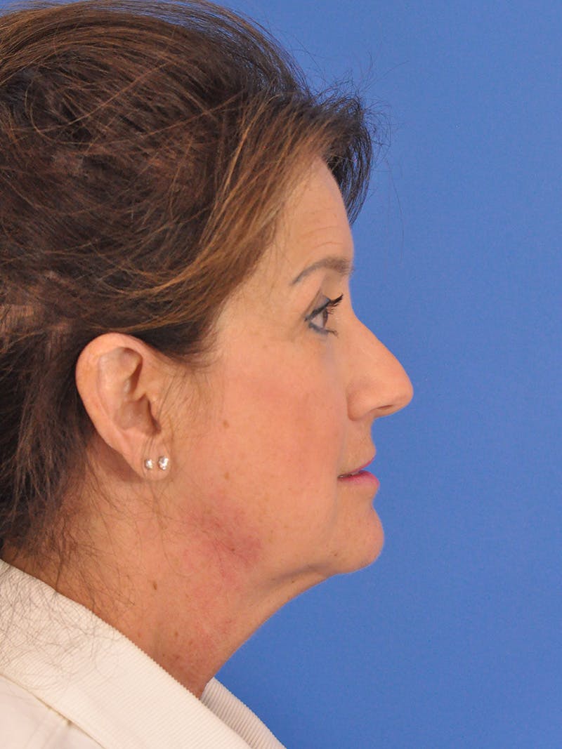 CO2RE Laser Before & After Gallery - Patient 326267 - Image 5