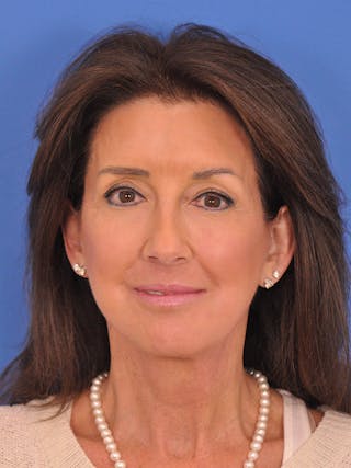 Brow Lift Before & After Gallery - Patient 175223 - Image 2