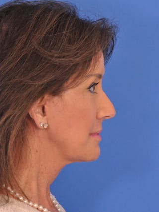 Brow Lift Before & After Gallery - Patient 175223 - Image 6