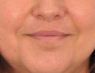 Lip Lift Before & After Gallery - Patient 349061 - Image 4