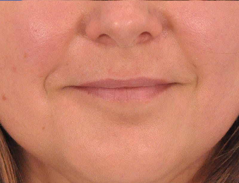 Lip Lift Before & After Gallery - Patient 349061 - Image 3
